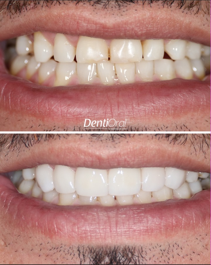 dentioral