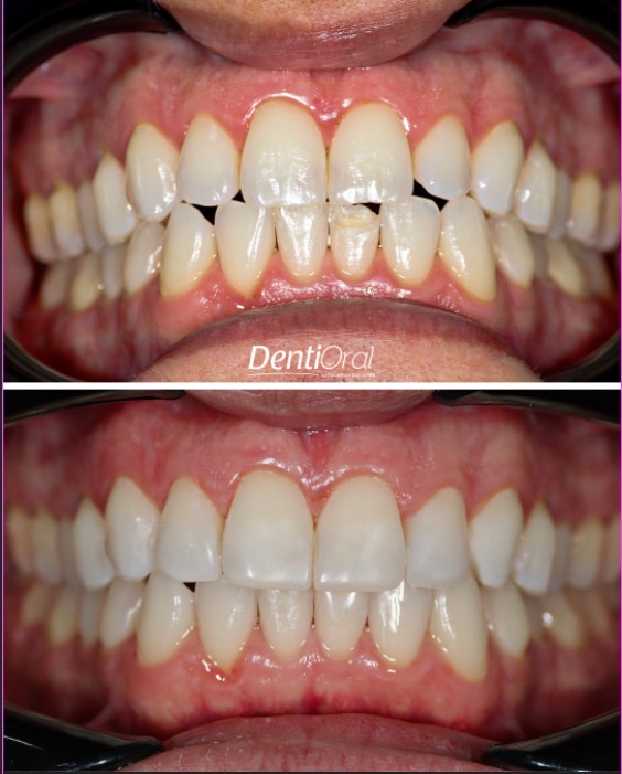 dentioral