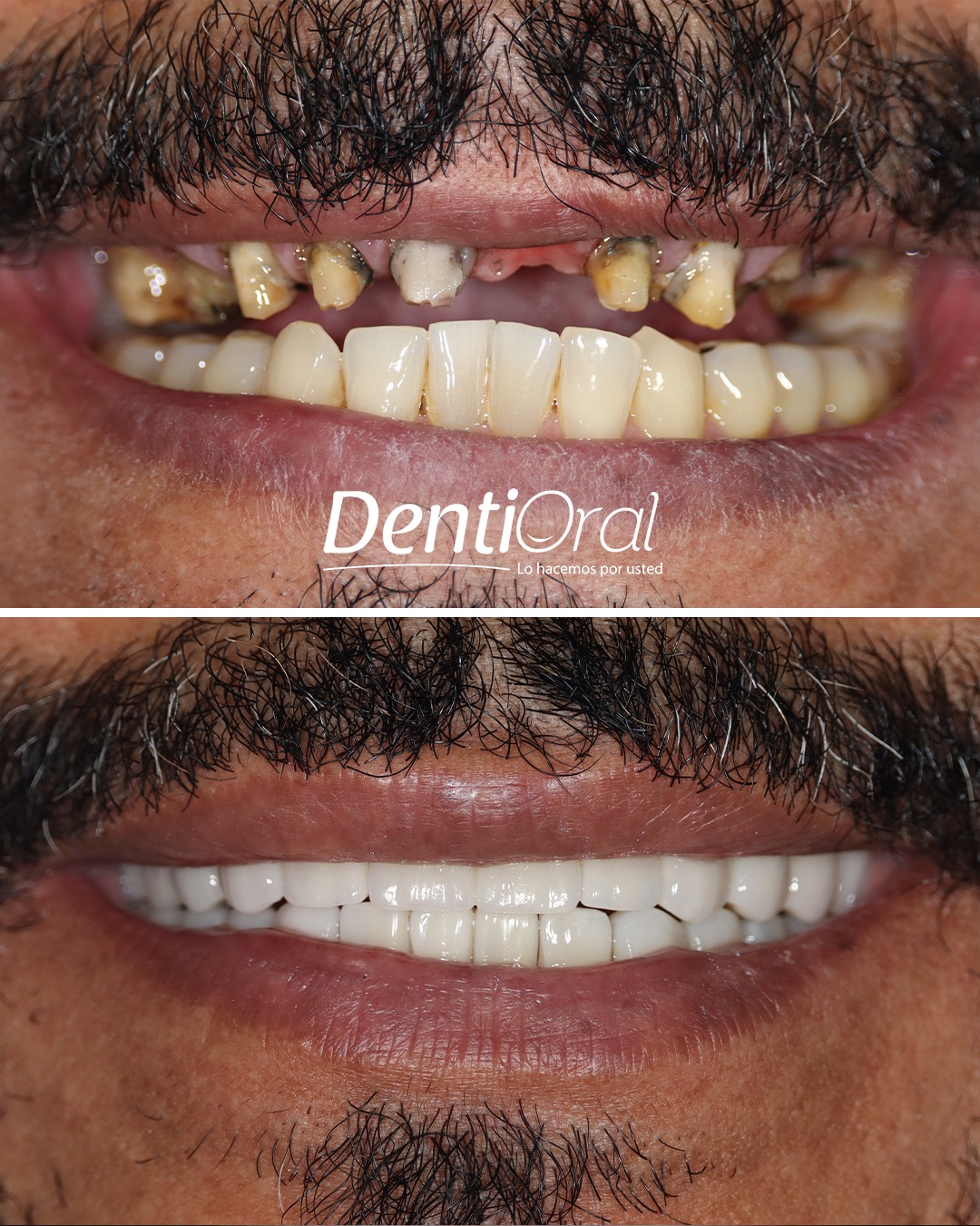 dentioral