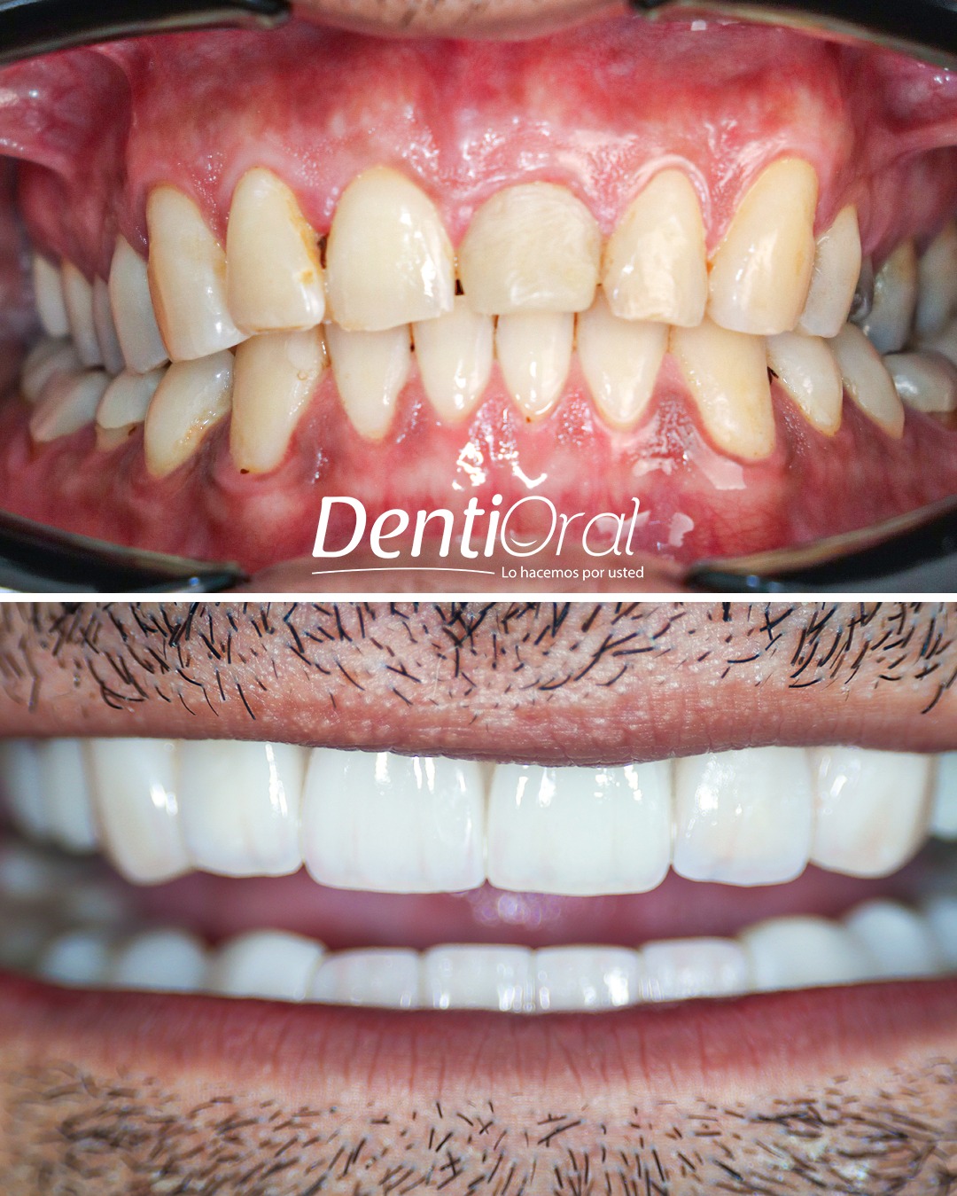 dentioral