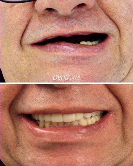 dentioral