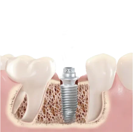Implante dental