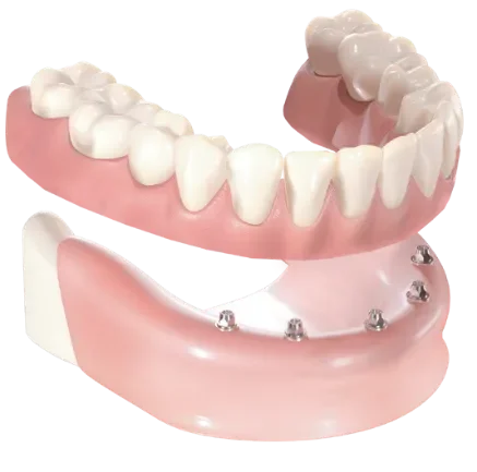 Implantes dentales