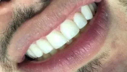 Caso de éxito de carillas dentales en DentiOral