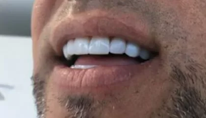 Caso de éxito de carillas dentales en DentiOral