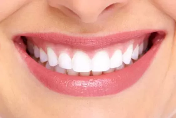 Diseño de sonrisa en Medellín