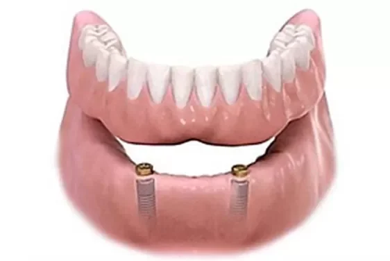 Prótesis dentales en Medellín