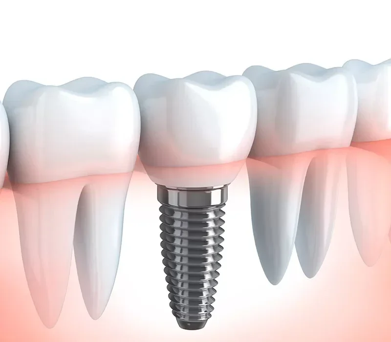 Benefits of dental implants over other restorative options