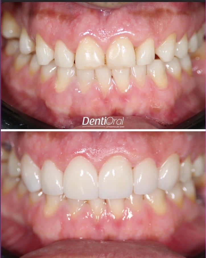 dentioral