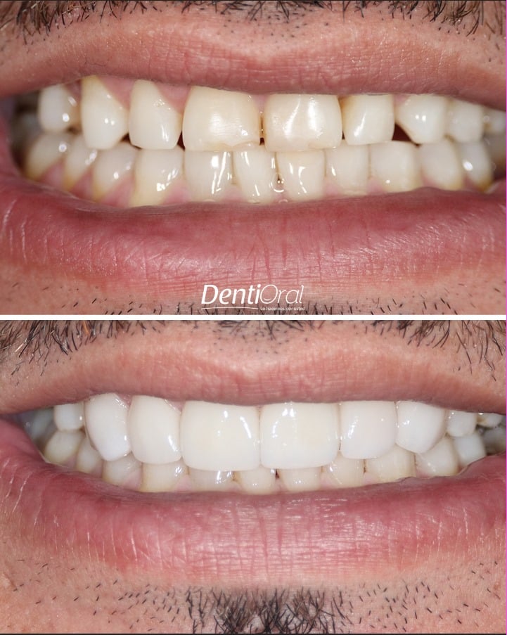 dentioral