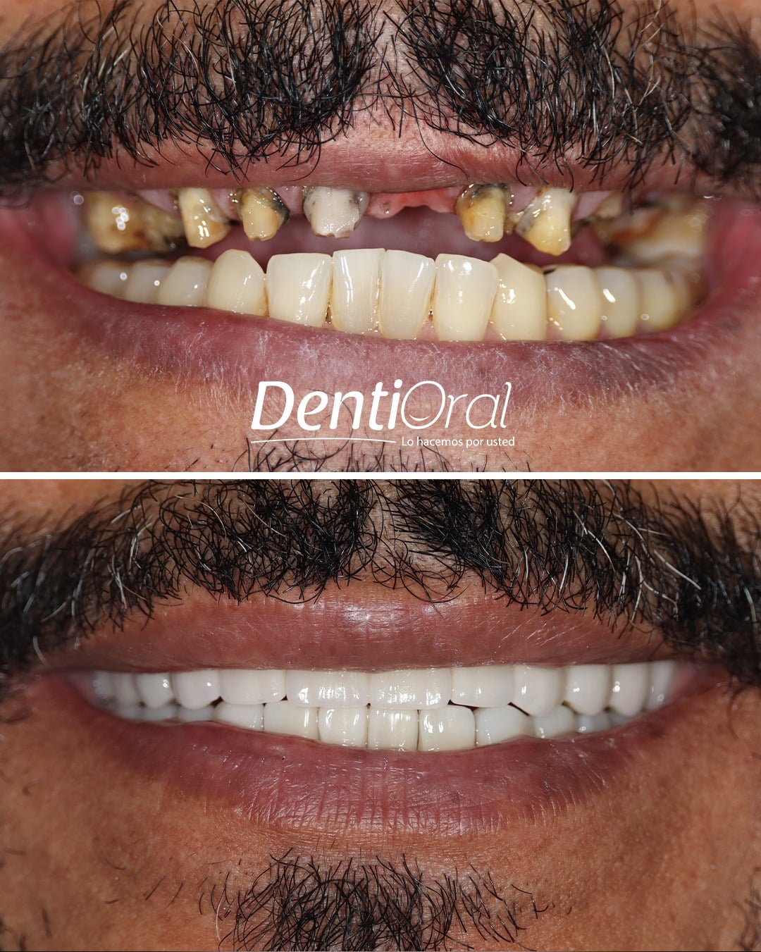 dentioral