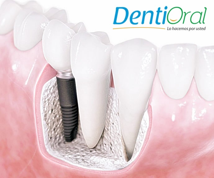 Principales ventajas de los implantes dentales