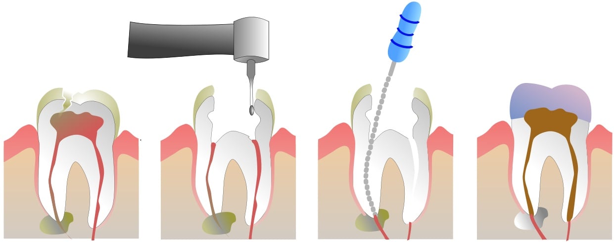 Tratamientos Dentales: Endodoncia