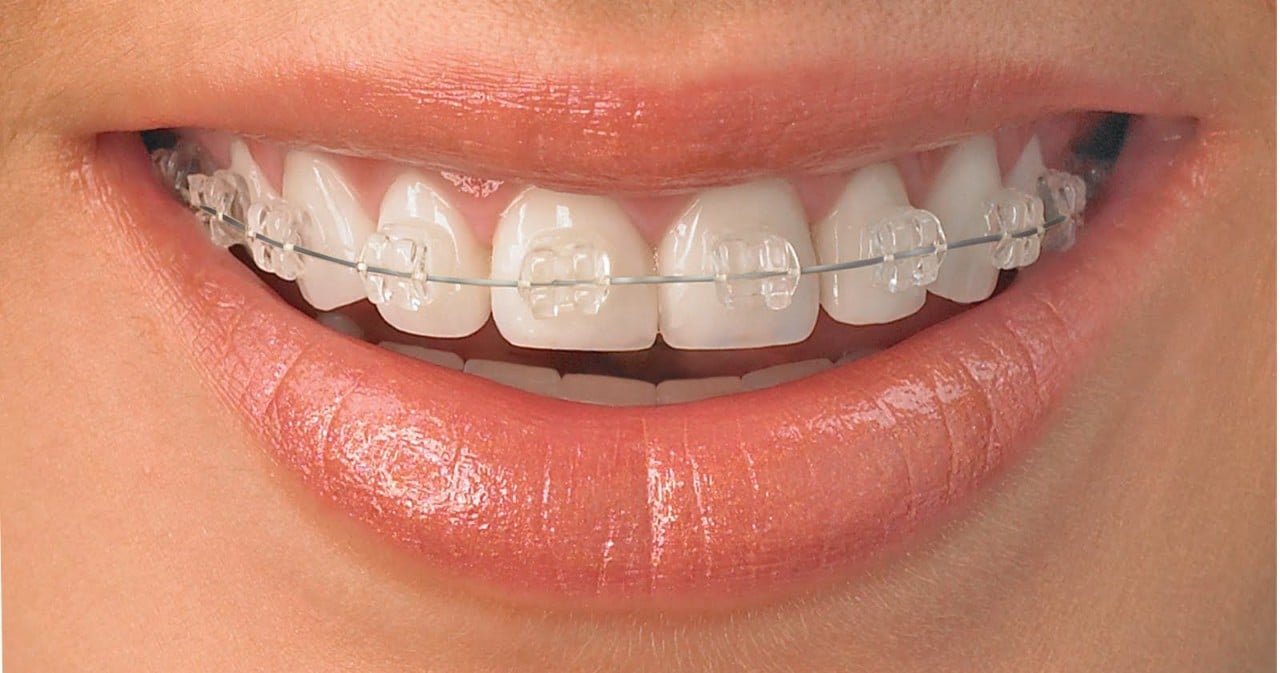 Cómo mantener una buena higiene oral durante el tratamiento de ortodoncia invisible