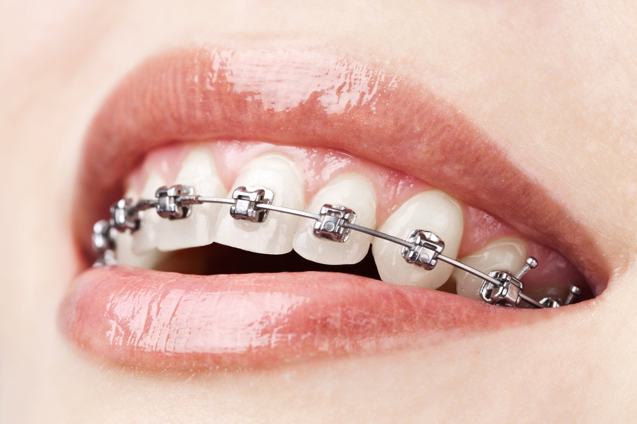 Ortodoncia con Mini Brackets