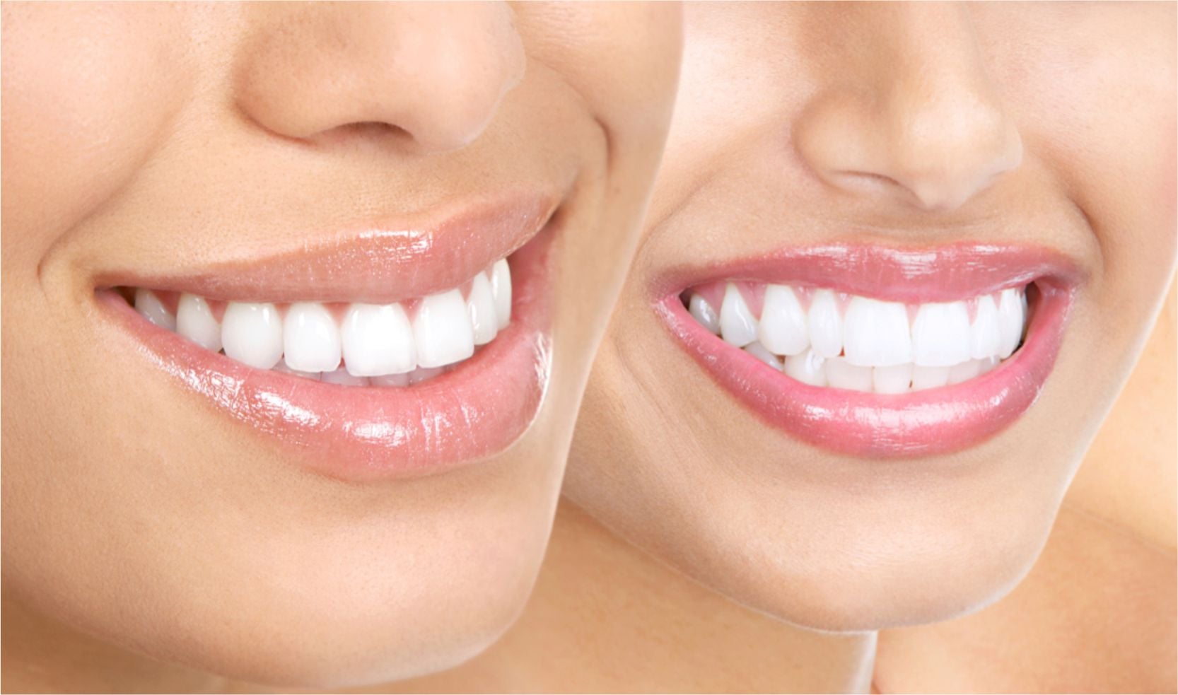 ¿Qué es el diastema dental y cómo corregirlo?