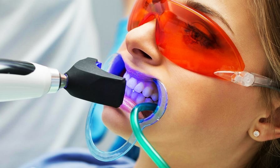 Blanqueamiento Dental: ¿Hazlo tú mismo o visita al especialista dental?