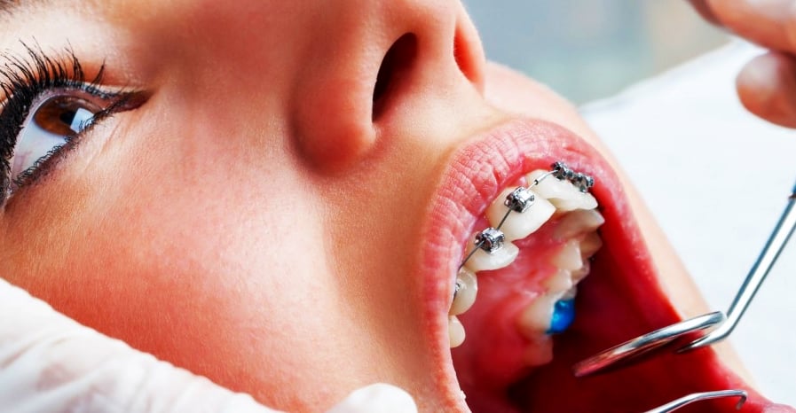Aprende a cuidar de tus dientes teniendo brackets