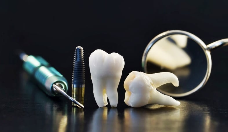 Las preguntas más frecuentes sobre los implantes dentales