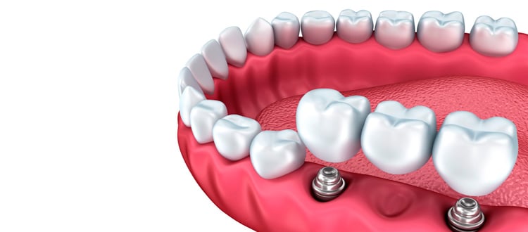 Las prótesis dentales y su razón de ser en la odontología