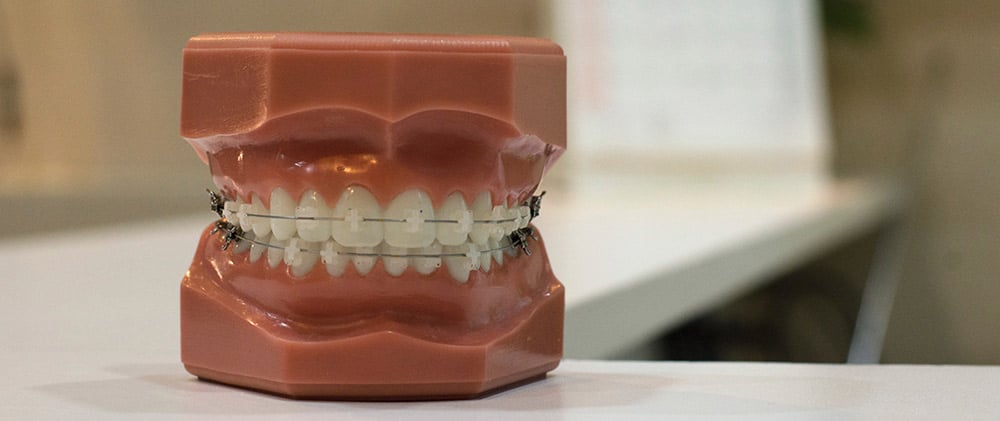 Ventajas de adquirir una ortodoncia con Dentioral