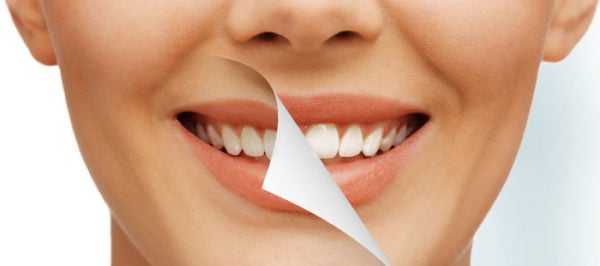 Efectos secundarios del blanqueamiento dental
