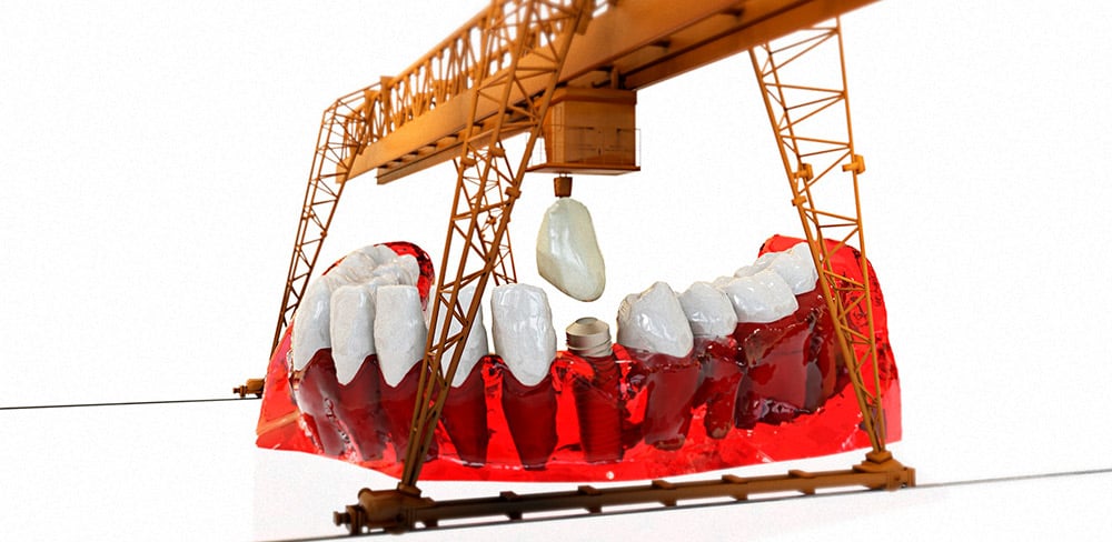 Todo lo que deben saber sobre las prótesis dentales