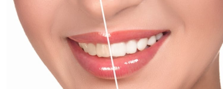 Tipos de blanqueamiento dental