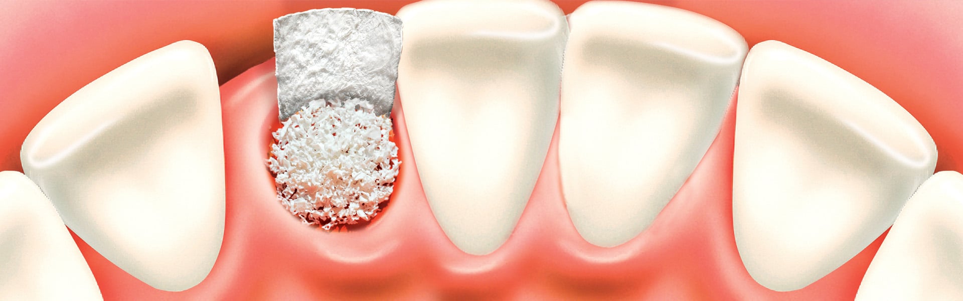Implantes dentales y regeneración ósea