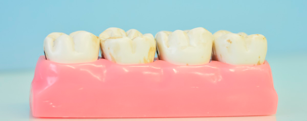 ¿Implante dental o prótesis?