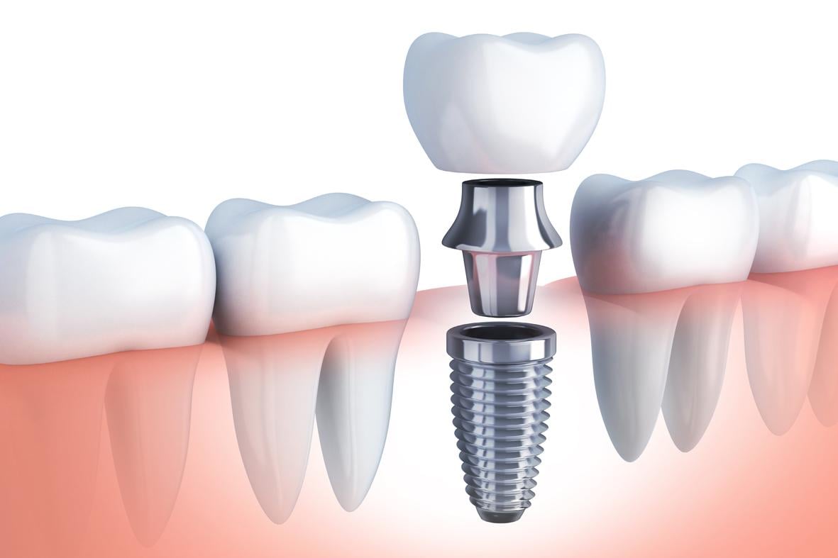 Tipos de implantes dentales