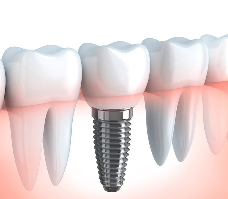 Los beneficios de los implantes dentales frente a otras opciones de restauración