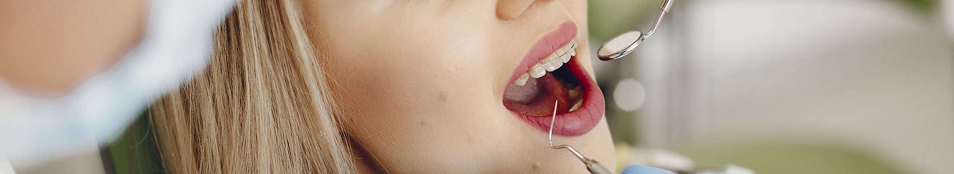 ¿Cuál es la importancia del sellado de dientes?