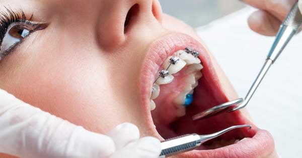 ¿Qué puede ocurrir si falla un tratamiento de ortodoncia?