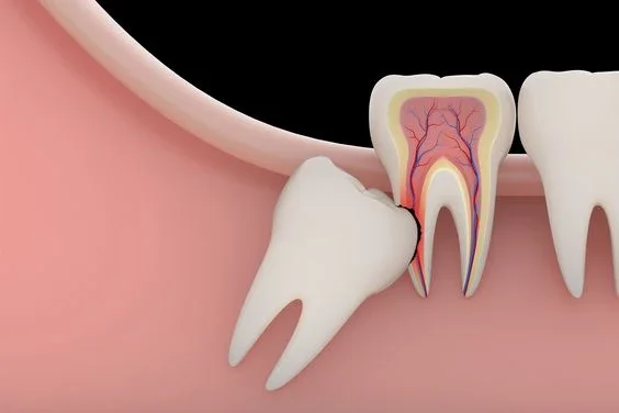 ¿Cómo saber si tienen pericoronaritis y cómo tratarla?