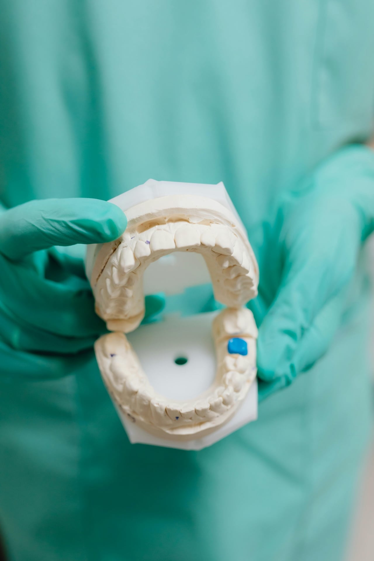 ¿Prótesis dentales o un implante dental, cuál es la mejor opción?