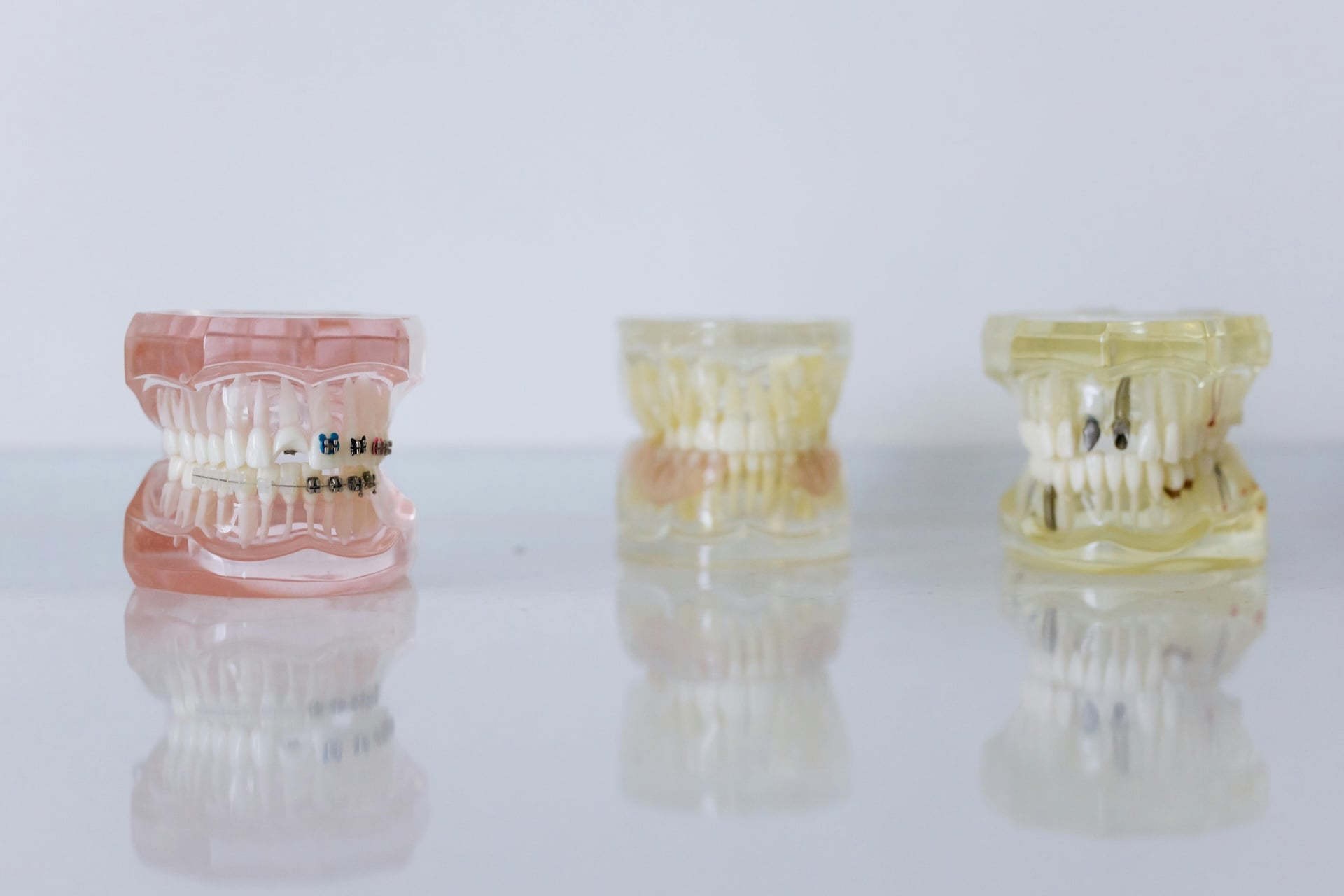 Principales diferencias entre las prótesis y los implantes dentales