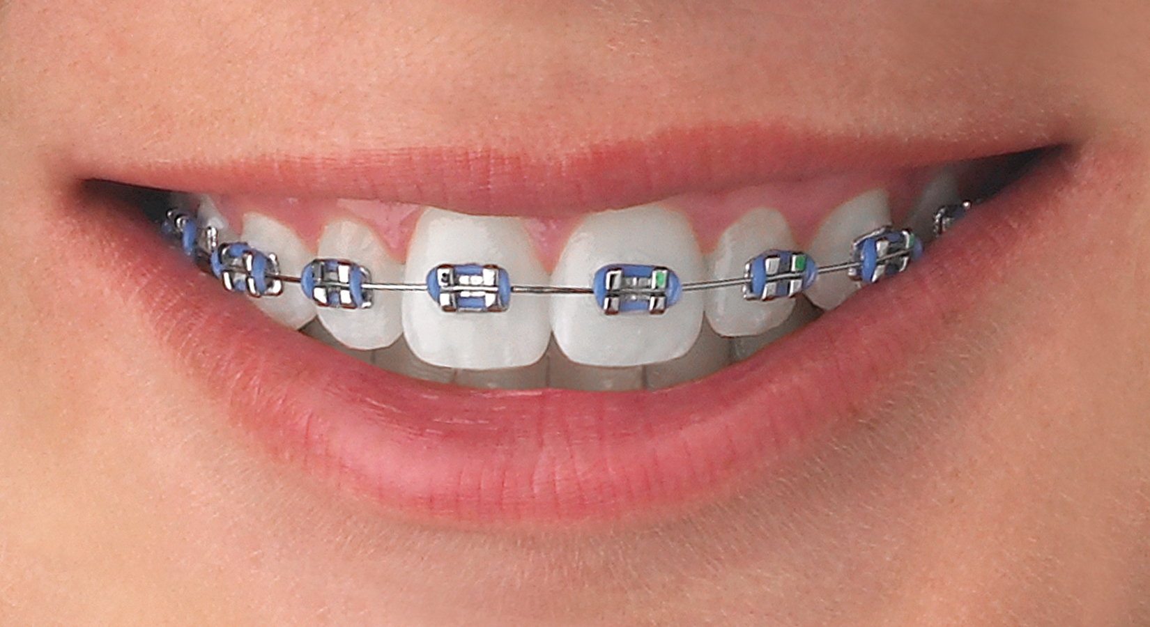 Cómo elegir los colores de tus Mini Brackets? - Clínica Odontológica  Dentioral